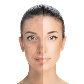 Pigmentation and discoloration treatment