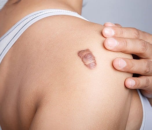 Keloid Treatment