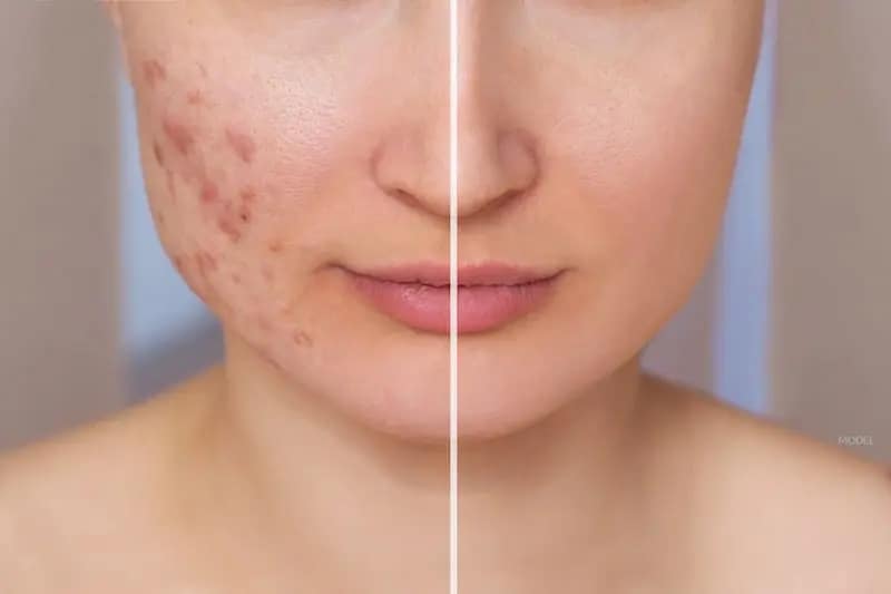 Acne Scar treatment